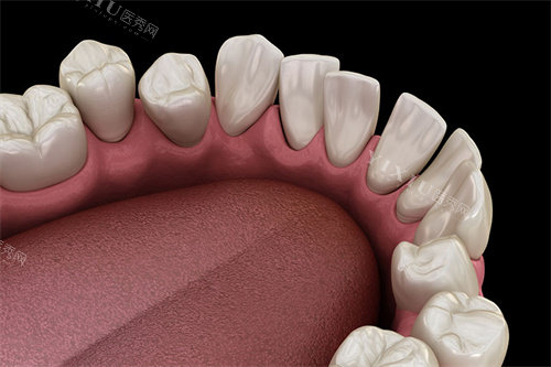 牙齿不整齐内侧视角