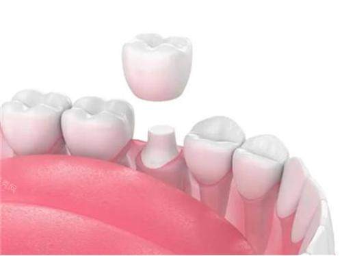 牙齿戴牙冠示意图