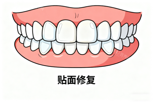 牙齿贴面修复卡通图