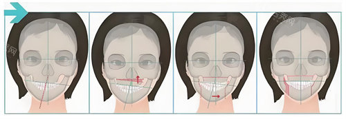 正颌手术手术步骤展示动画图