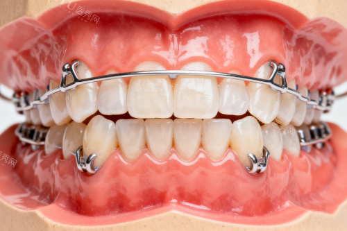 牙齿保持器模型一览