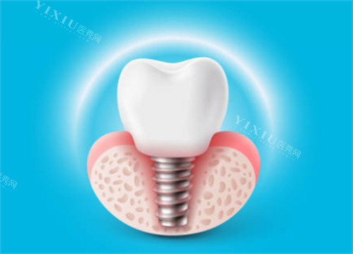 种植牙有光圈示意图