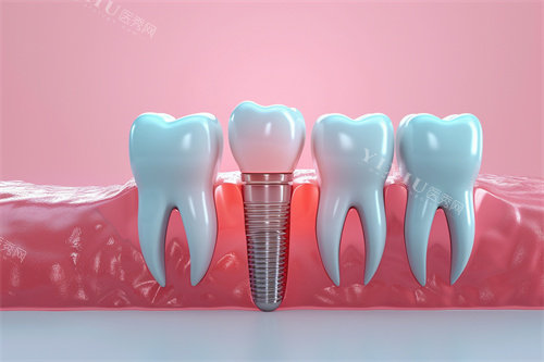 种植牙漫画模型解剖图