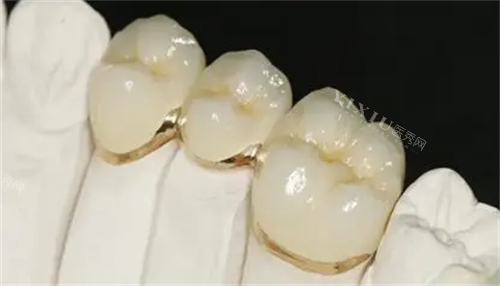 烤瓷牙安装成效展示图