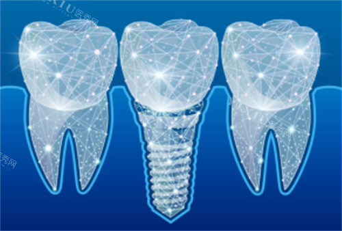 种植牙科技感卡通