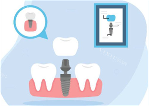 种植牙种植过程