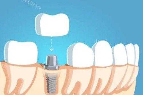 种植牙戴牙冠卡通图
