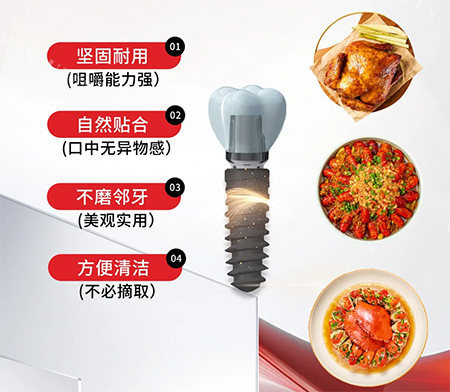 安特种植牙特色优点