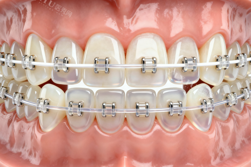 陶瓷半隐形矫正器卡通图片展示