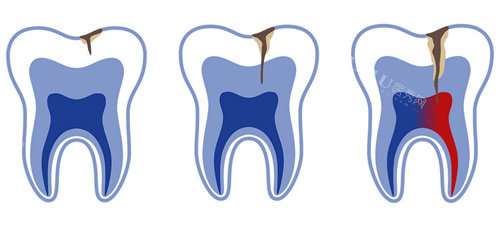 牙釉质牙齿龋坏不同程度