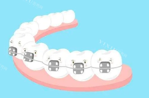 传统牙齿矫正器动画展示图