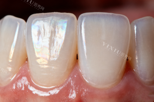 重庆孟思妤口腔2025收费标准：隐适美矫正30000元起、韩种植牙4500元起、补牙170元起技术靠谱！(图5)