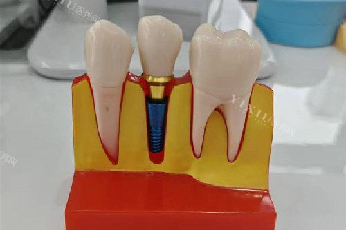 种植牙模型实拍