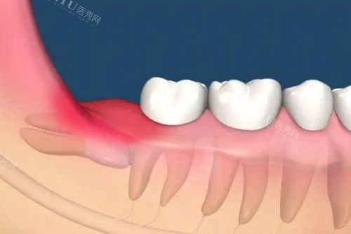 智齿发炎卡通体