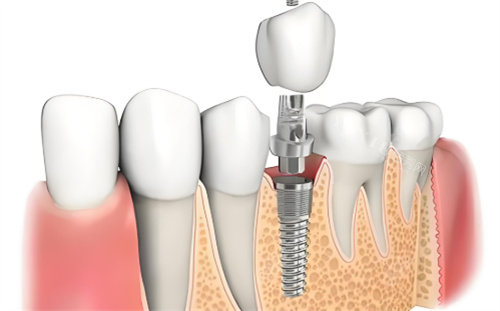 种植牙材料展示