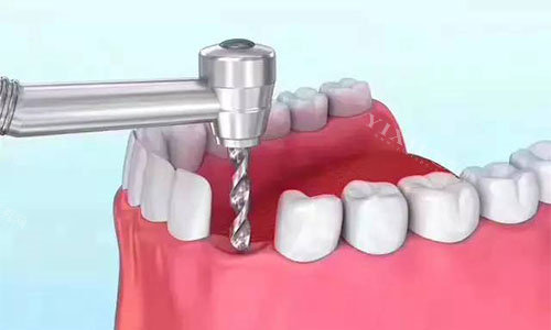 种植牙准备种植窝