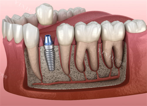 种植牙解剖模型
