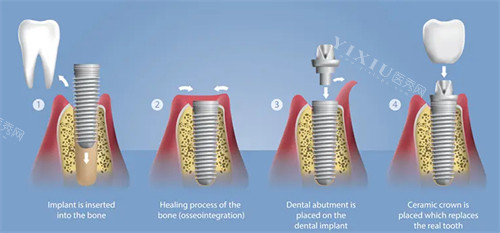 种植牙手术流程图