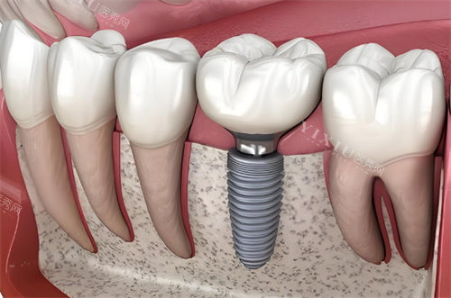 种植牙动画示图