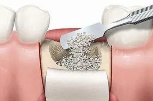 种植牙植骨图片展示