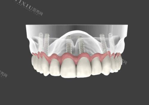 半口种植牙模型图