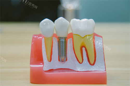 牙科种植牙模型