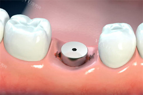 单颗种植牙愈合基台