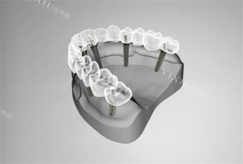 半口种植牙模拟示意图