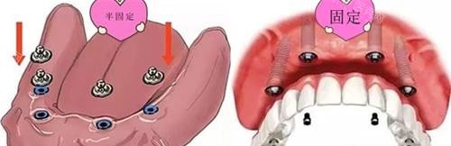 半口半固定种植牙