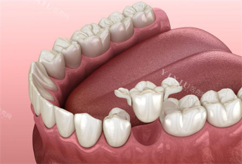 牙齿修复动画展示图