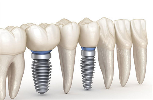 种植牙动画图片展示