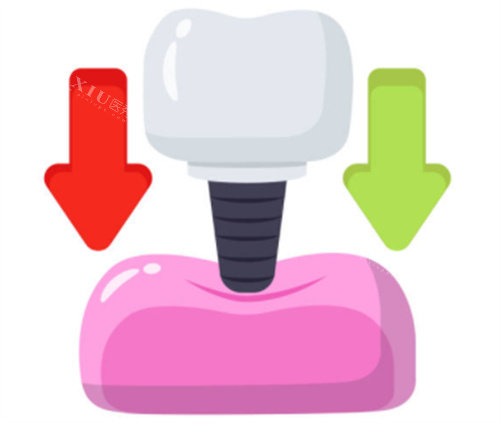 种植牙的用力示意图