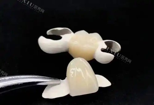 hpp粘接桥牙齿示意图