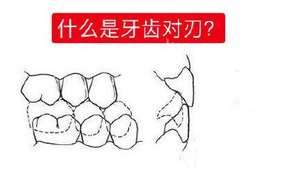 什么是牙齿对刃