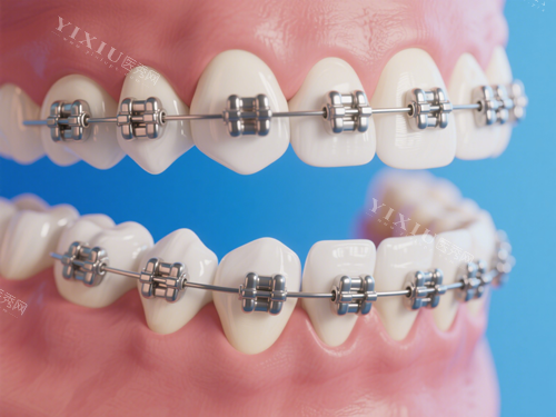 金属托槽牙齿矫正特写