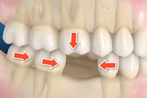 牙齿缺一颗不补的影响图