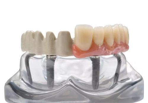 peek支架半口修复义齿