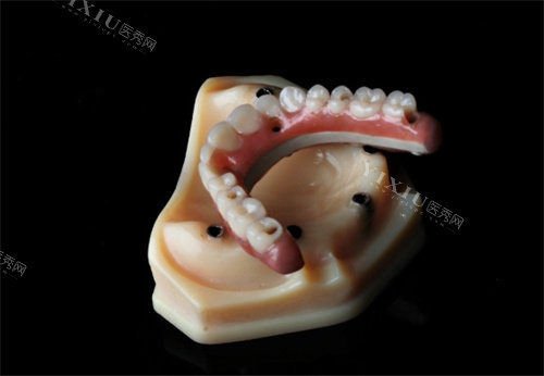 peek支架半口假牙