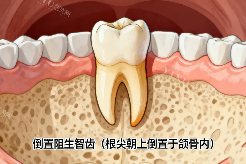 倒置阻生智齿展示图