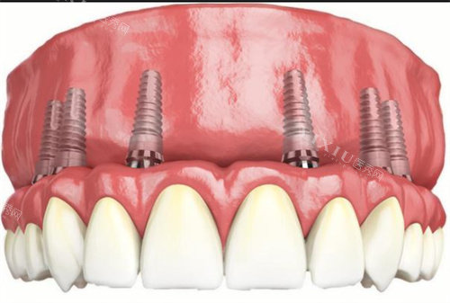 全口种植牙动画示意图