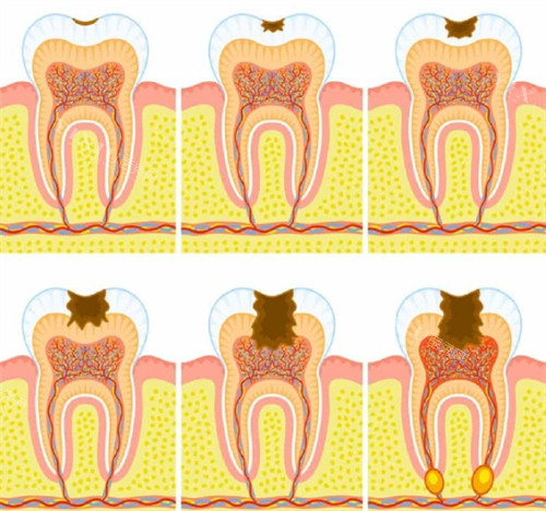 需要根管治疗的牙齿