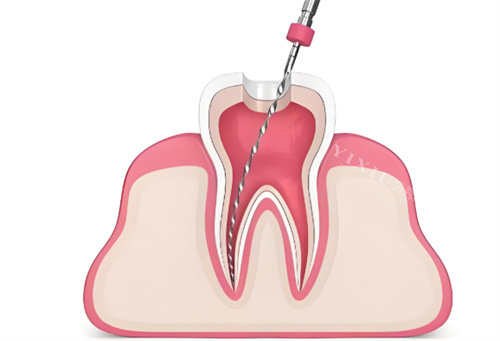 根管治疗卡通展示