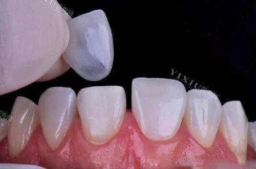牙齿贴面过程