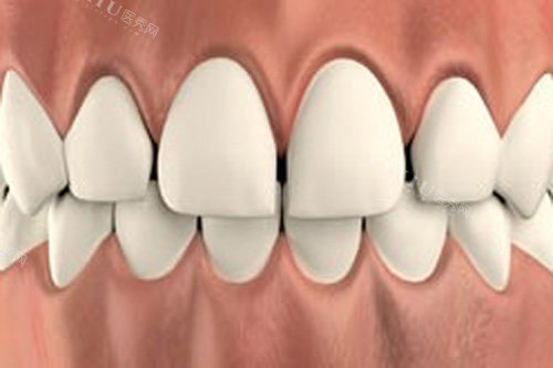 牙齿稀疏示意图