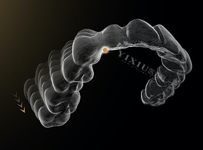 时代天使隐形正畸特色