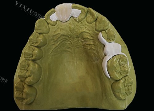 hpp粘接桥牙齿口腔内示意图