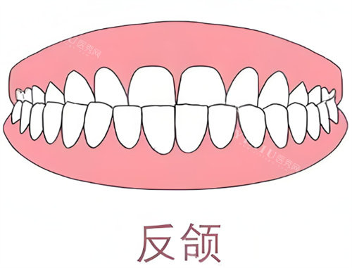 牙齿反颌卡通示意图