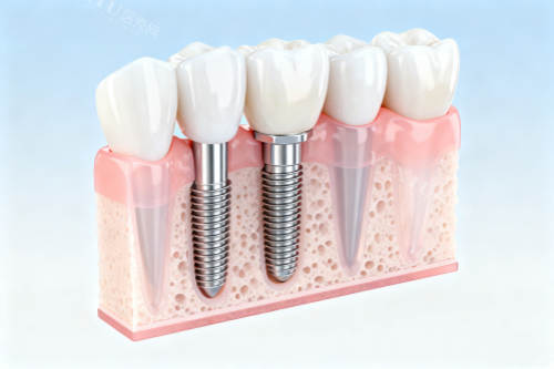 牙齿缺牙修复卡通图展示