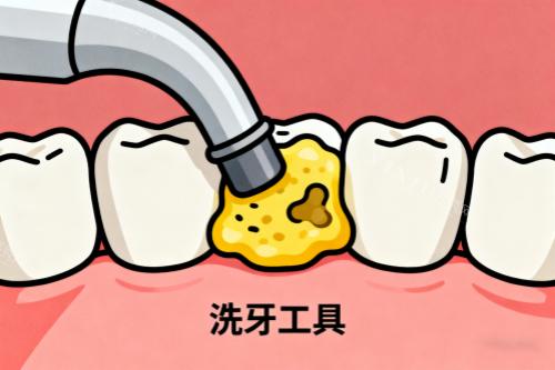 清洗牙齿脏东西展示图