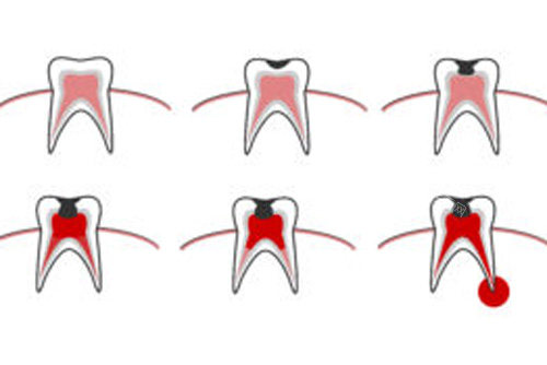 牙齿疼痛内部示意图